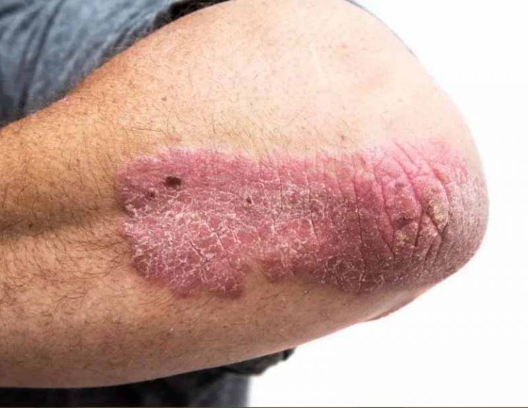 Apa Itu Psoriasis Apa Gejala dan Penyebabnya 